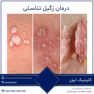 درمان زگیل تناسلی