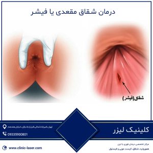 درمان شقاق مقعدی یا فیشر