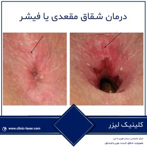 درمان شقاق مقعدی یا فیشر