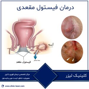 درمان فیستول مقعدی