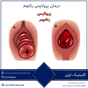درمان پرولاپس رکتوم