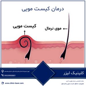 درمان کیست مویی