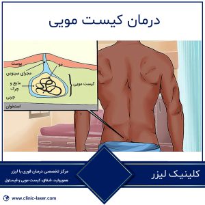 درمان کیست مویی