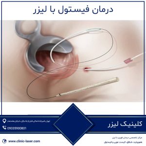 درمان فیستول با لیزر