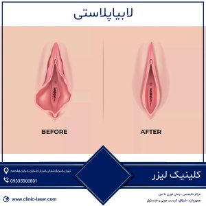 لابیاپلاستی