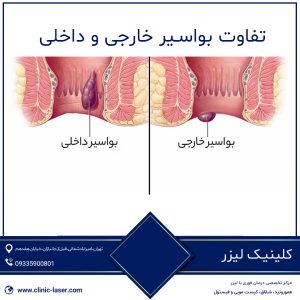 تفاوت بواسیر خارجی و داخلی