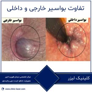 تفاوت بواسیر خارجی و داخلی