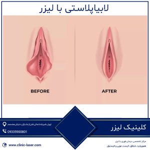 لابیاپلاستی با لیزر