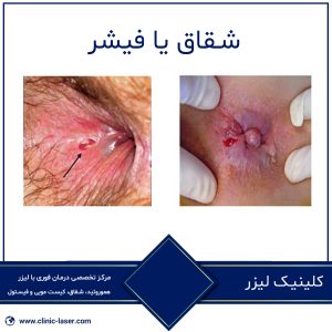 بهترین پماد شقاق