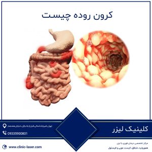 کرون روده چیست