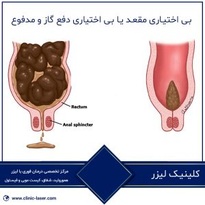 بی اختیاری مقعد یا بی اختیاری دفع گاز و مدفوع