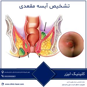 تشخیص آبسه مقعدی